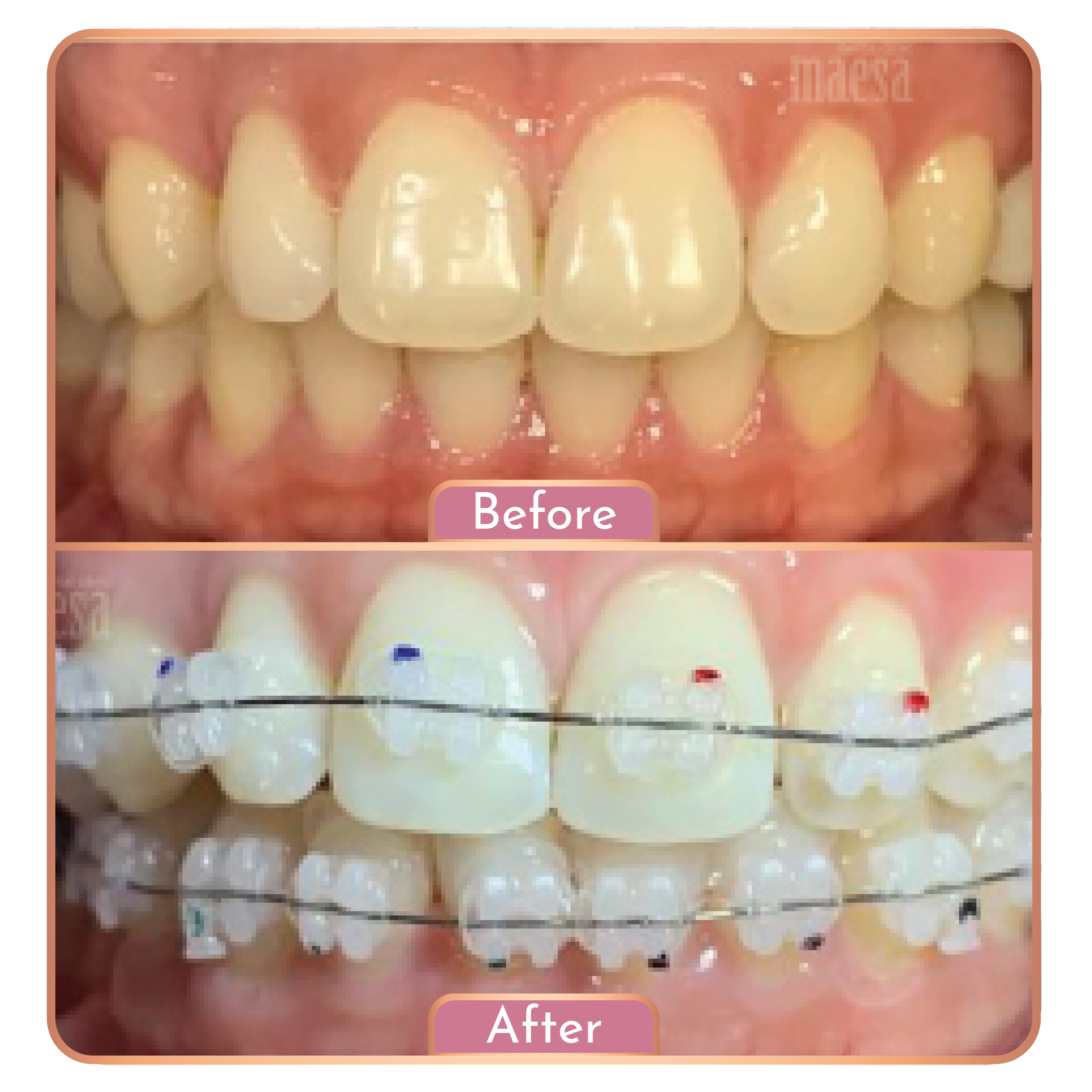 Treatment Maesa Dental Clinic | Klinik Gigi Terbaik - Behel Gigi (Ceramic)