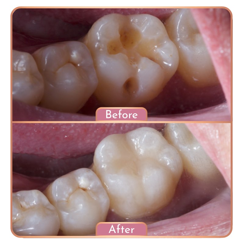 Treatment Maesa Dental Clinic | Klinik Gigi Terbaik - Penambalan Gigi