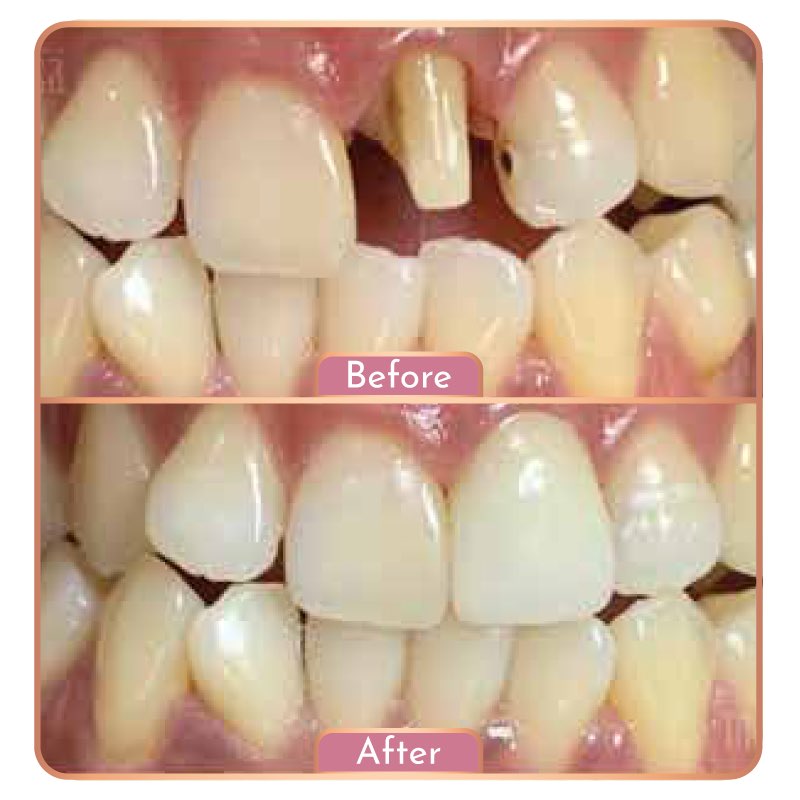 Treatment Maesa Dental Clinic | Klinik Gigi Terbaik - Gigi Palsu (Emax)