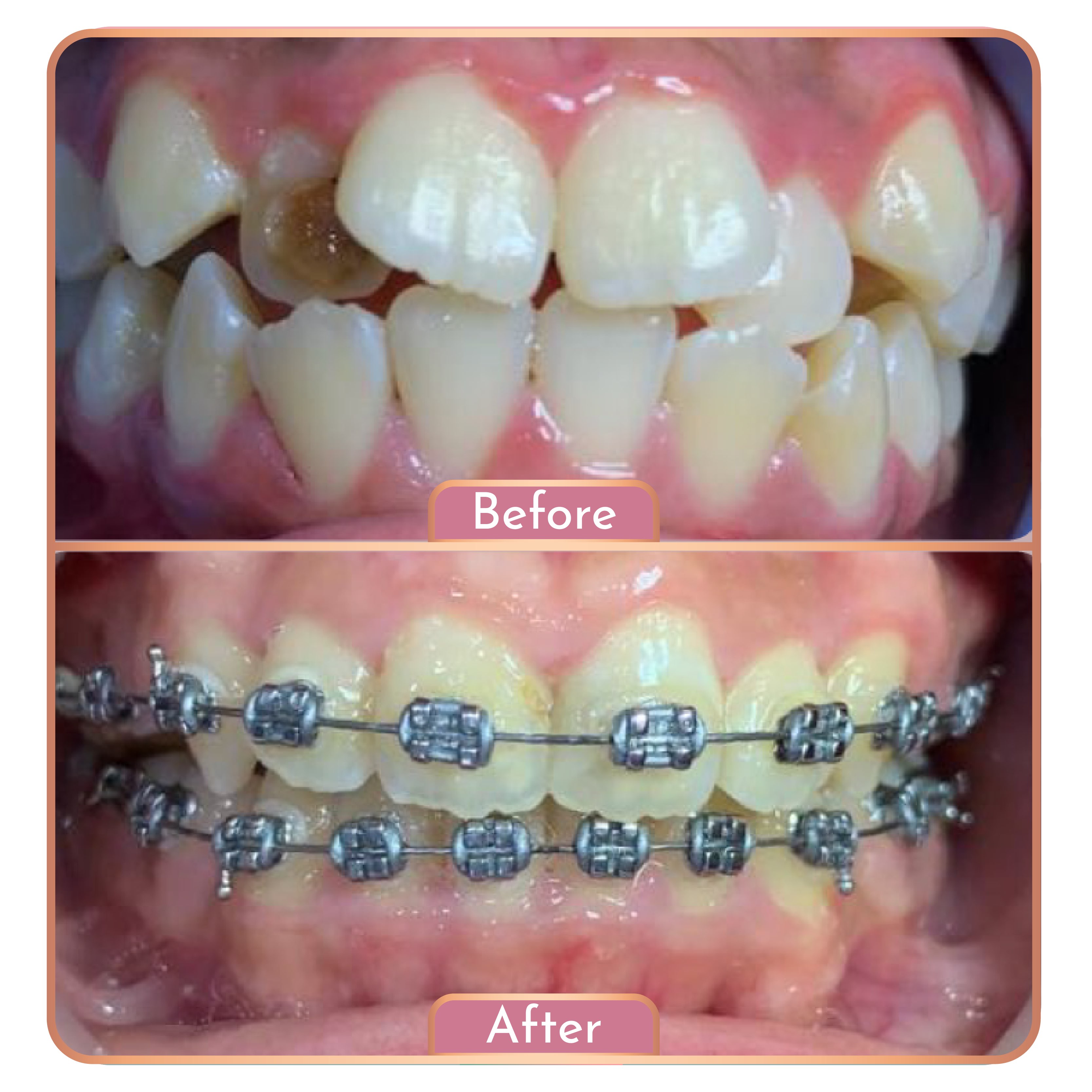 Treatment Maesa Dental Clinic | Klinik Gigi Terbaik - Behel Gigi (Metal)