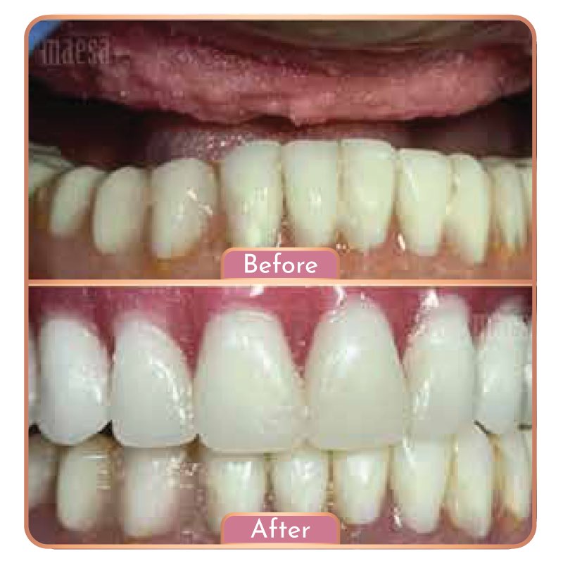 Treatment Maesa Dental Clinic | Klinik Gigi Terbaik - Gigi Palsu Lepasan