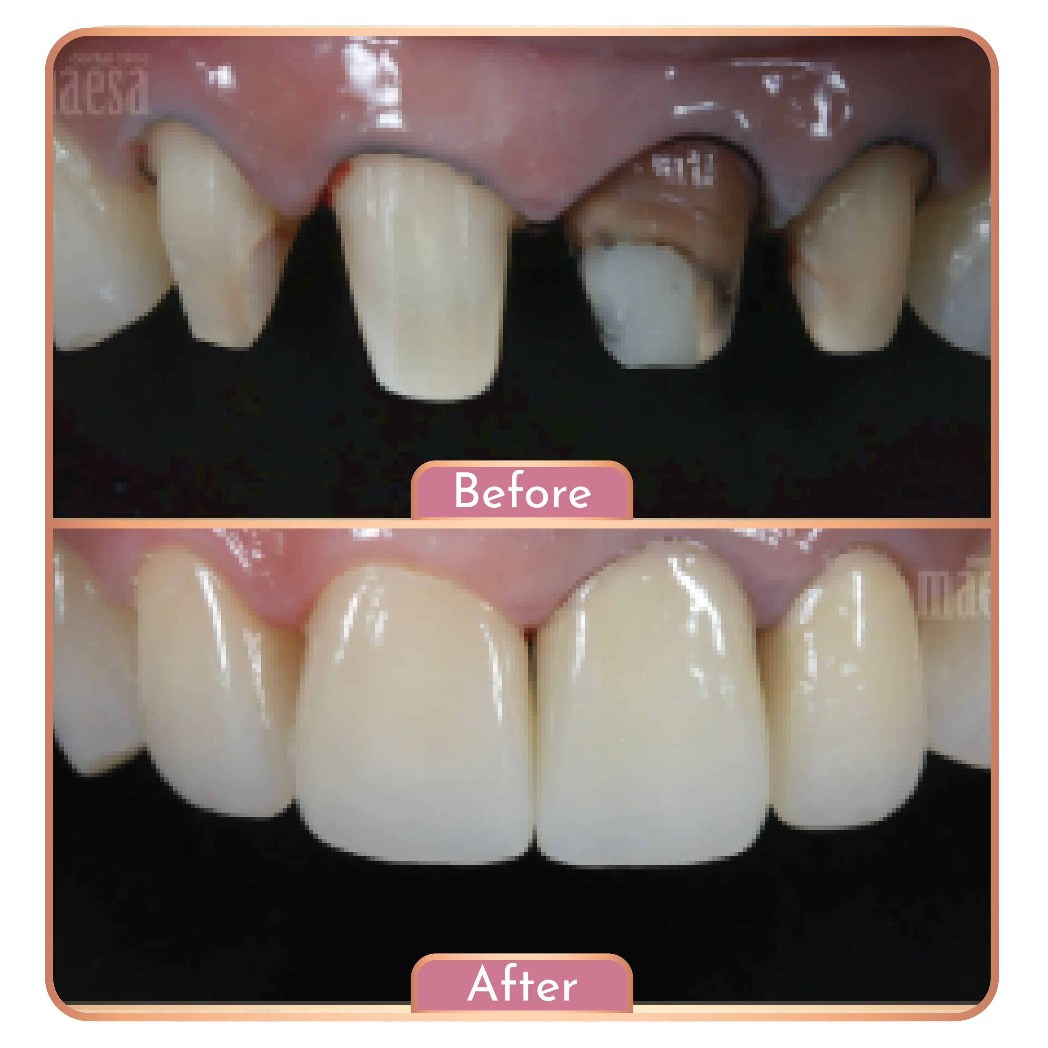 Treatment Maesa Dental Clinic | Klinik Gigi Terbaik - Gigi Palsu (Zirconia)