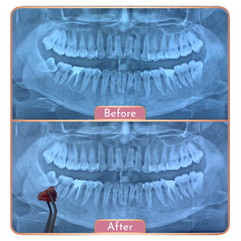 Treatment Maesa Dental Clinic | Klinik Gigi Terbaik - Pencabutan Gigi Bungsu