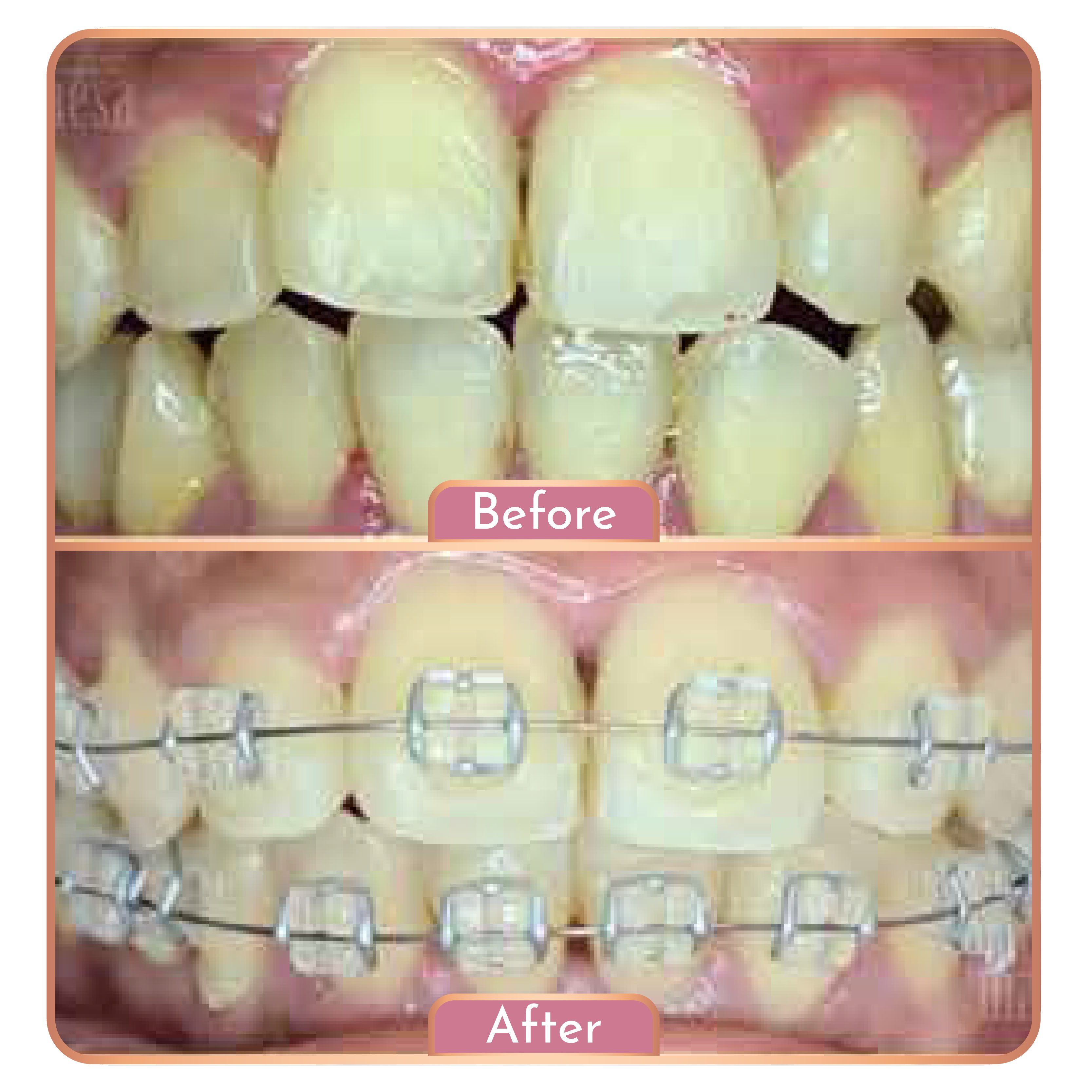 Treatment Maesa Dental Clinic | Klinik Gigi Terbaik - Behel gigi (Sapphire)