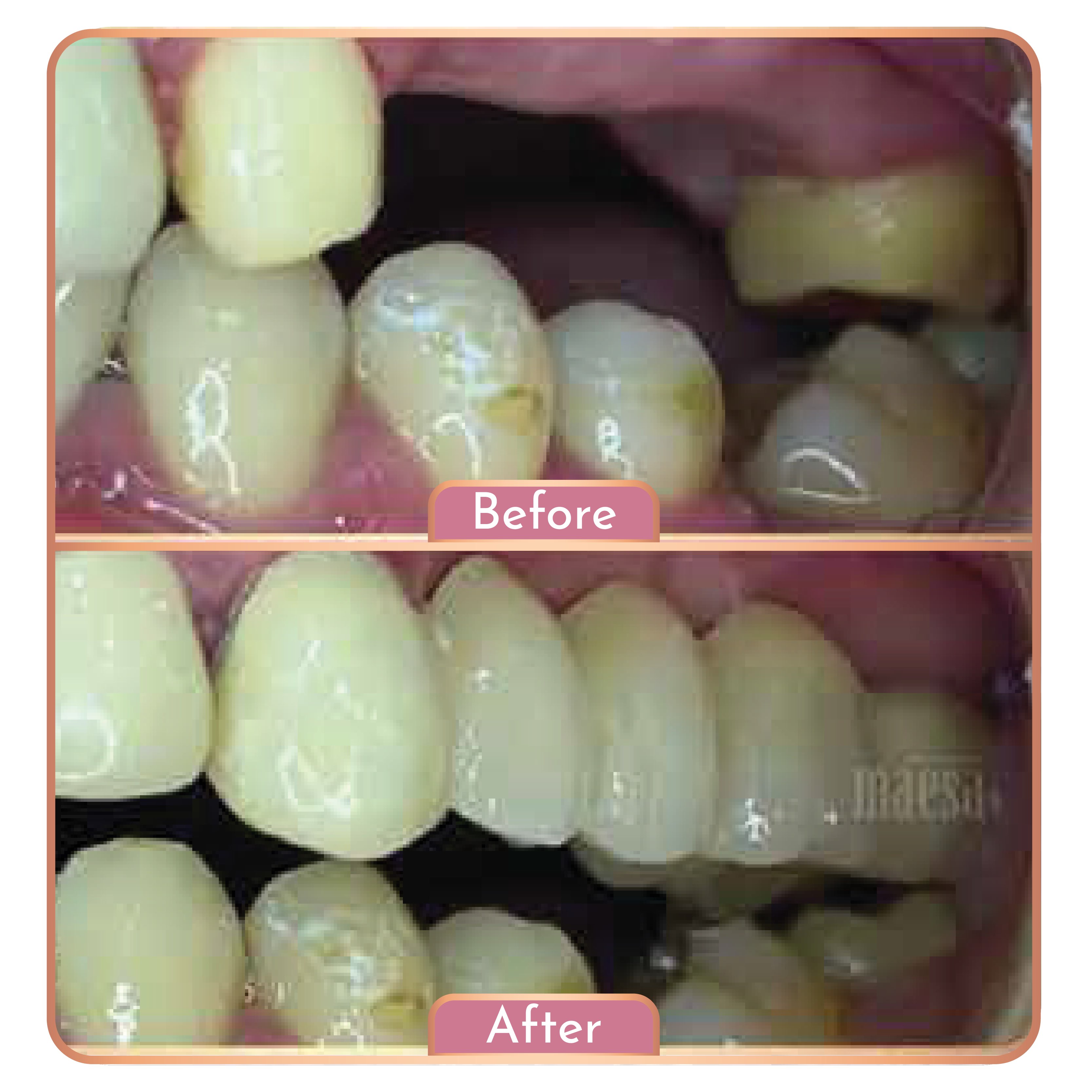 Treatment Maesa Dental Clinic | Klinik Gigi Terbaik - Gigi Palsu (PFM)